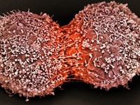 Новый тест поможет обнаружить рак молочной железы до формирования опухоли